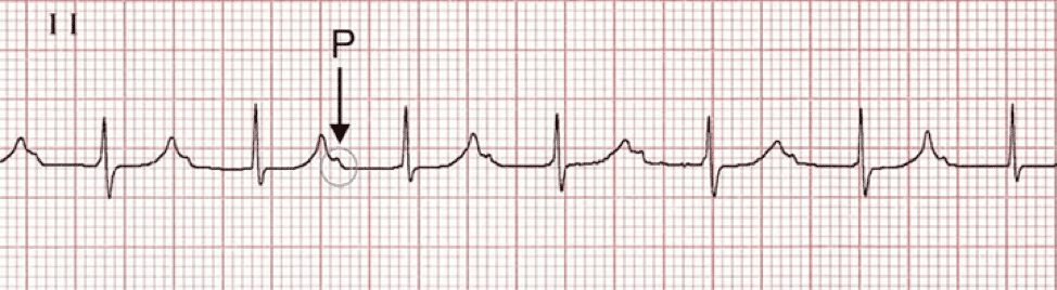 first degree av block