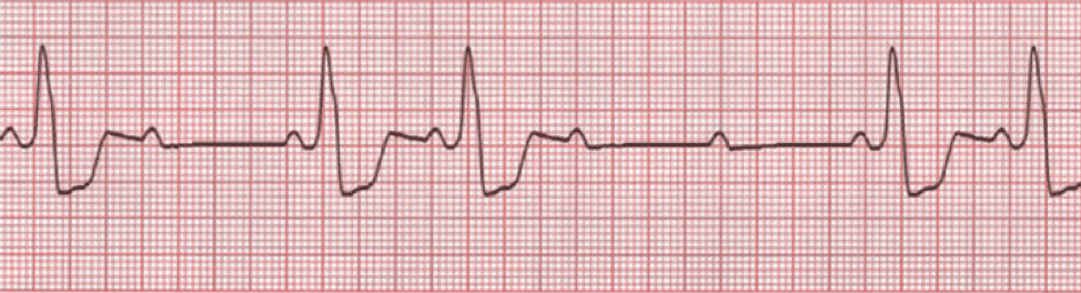 First-degree atrioventricular block - Wikipedia