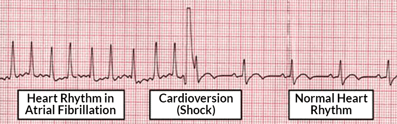 cardioversion