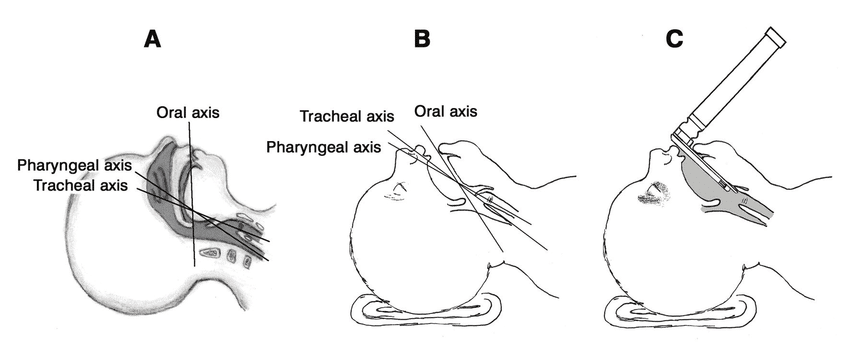 laryngoscopy