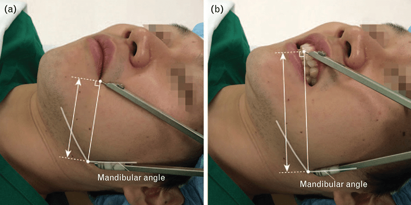 mandibular measurement example