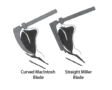 Curved Macintosh blade vs straight Miller blade