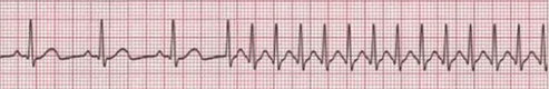 supraventricular tachycardia