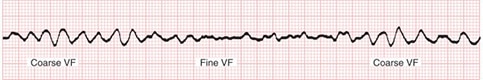 ventricular fibrillation