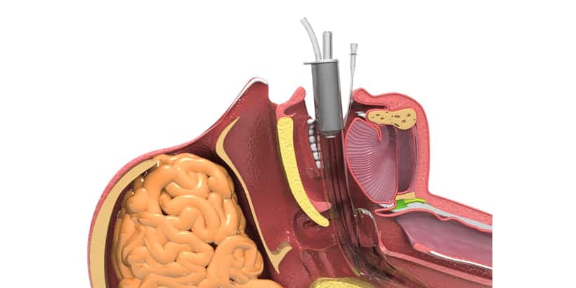 laryngeal mask airway